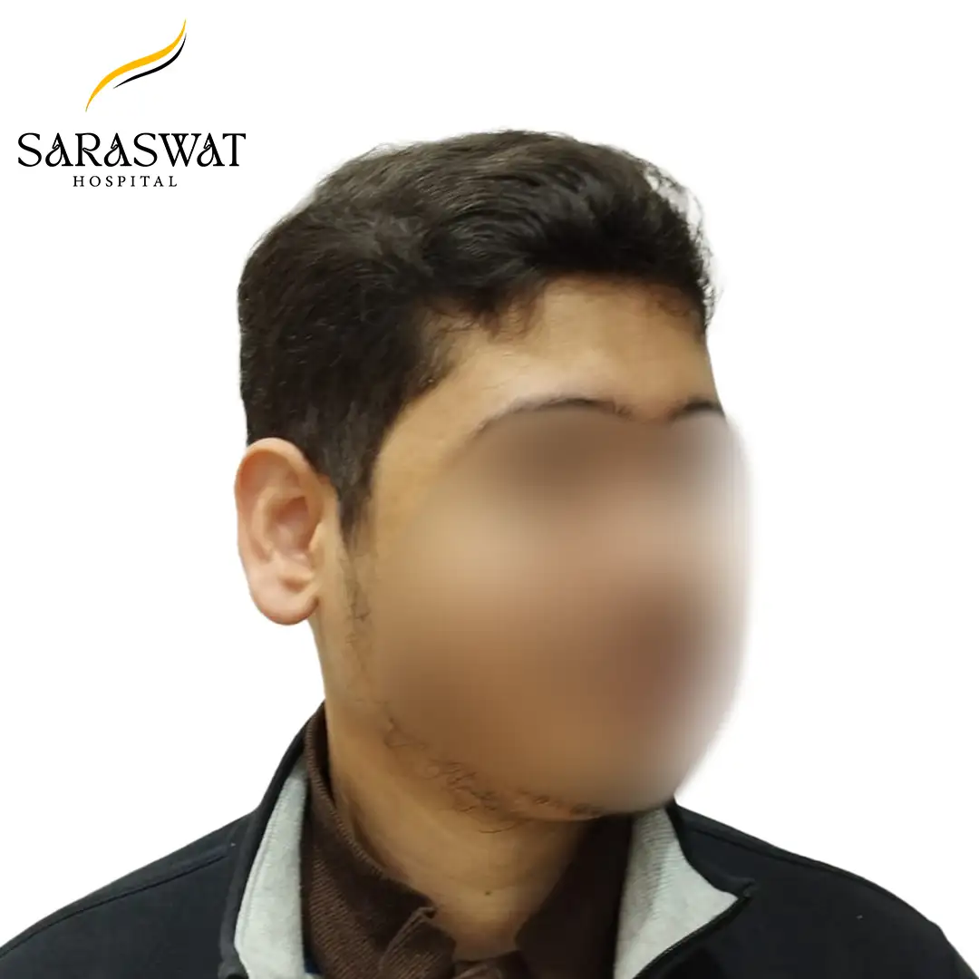 Hair Transplant Near me