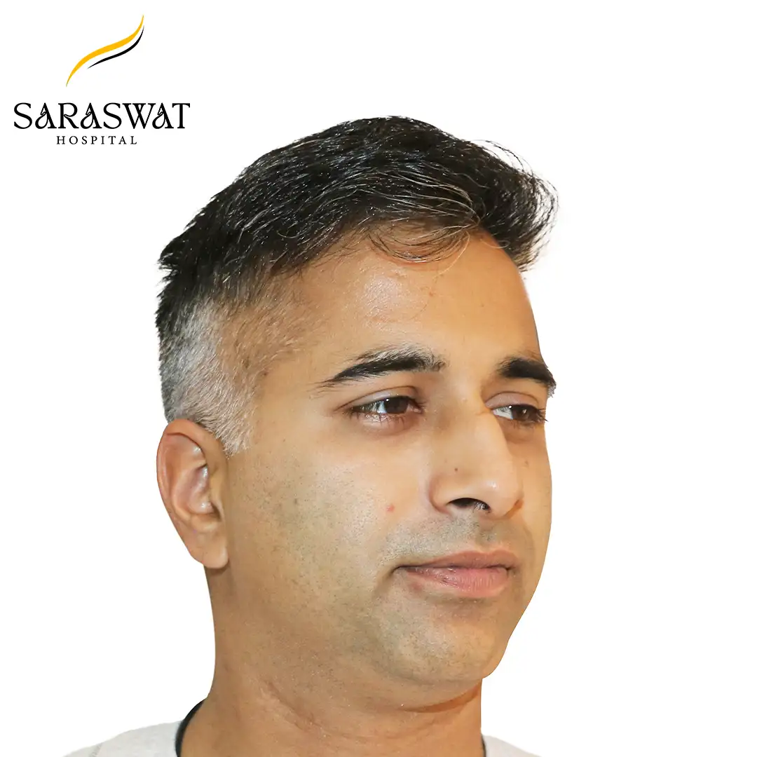 45 Degree Right FUE Hair Transplant Result After Procedure