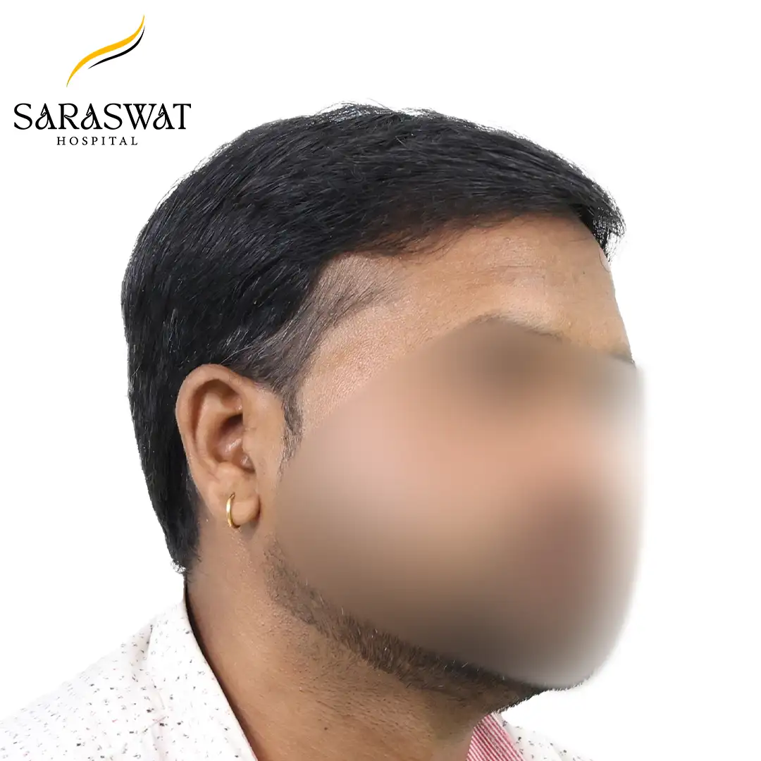 Hair Transplant Before After