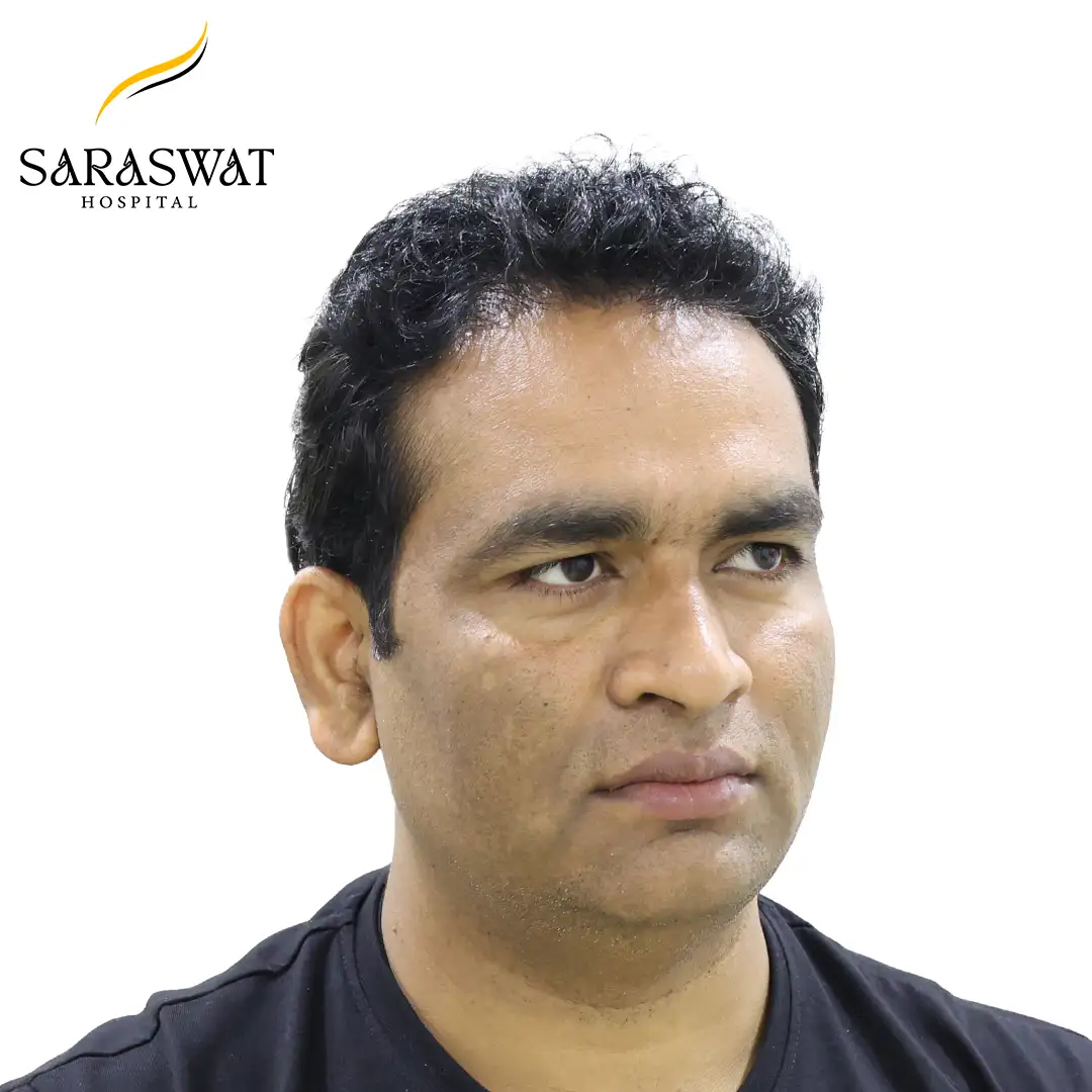 45 Degree Right FUE Hair Transplant Result After Procedure