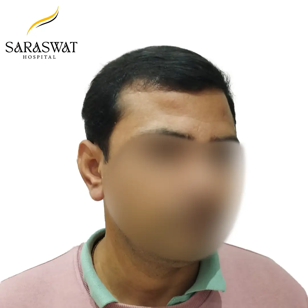 45 Degree Left FUE Hair Transplant Result After Procedure