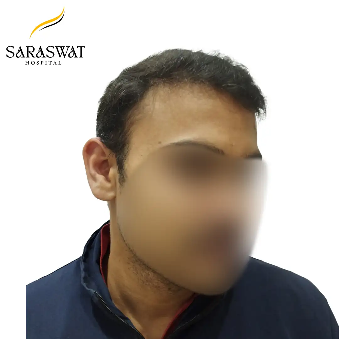 Hair Transplant Result