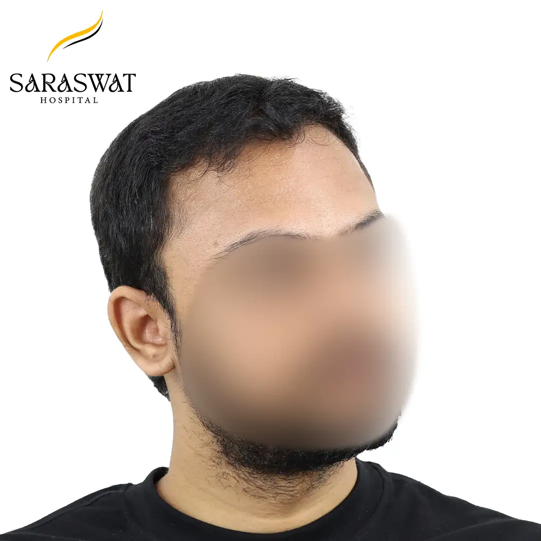 Hair Transplant Before and After Results