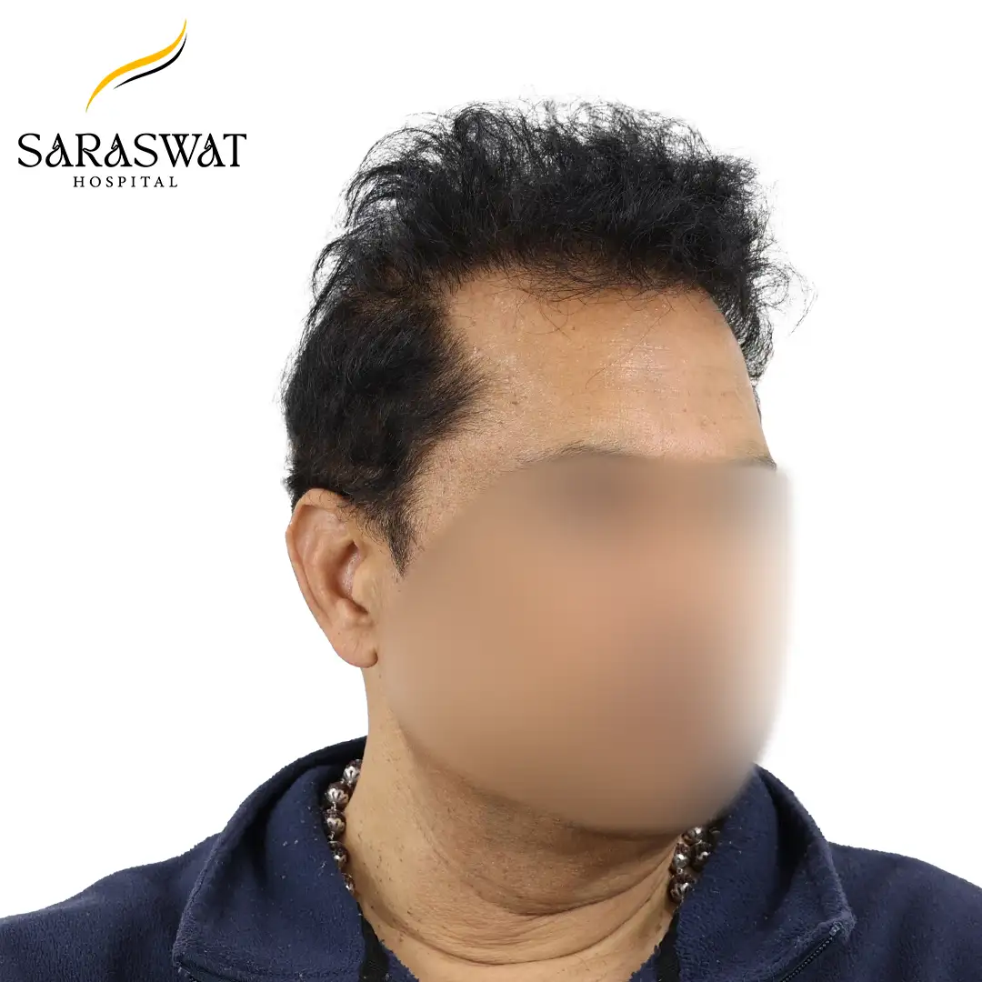 Best Hair Transplant Results
