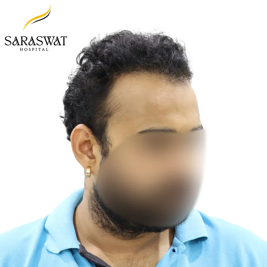 Hair Transplant Before and After Results