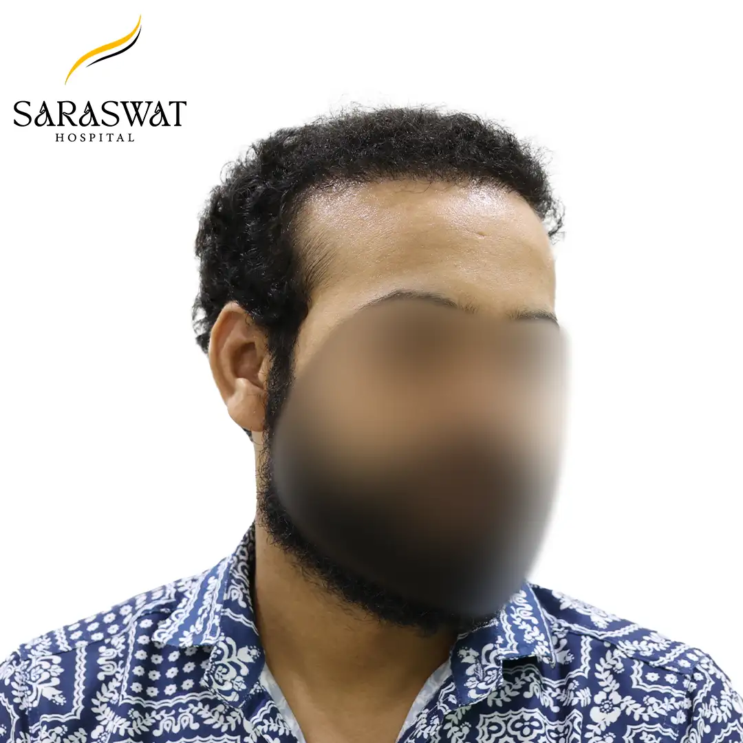 Hair Transplant Before and After Results