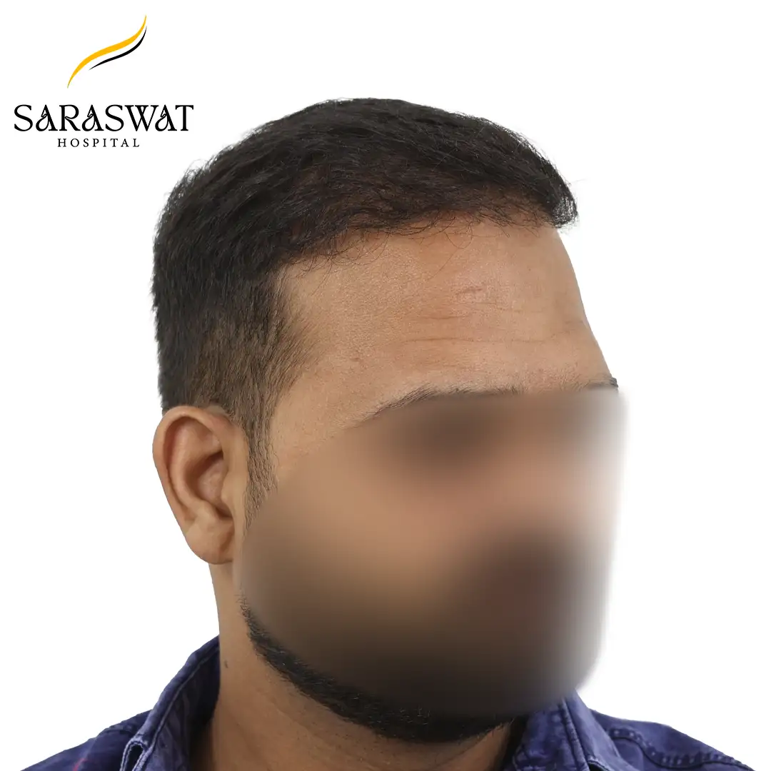 45 Degree Right FUE Hair Transplant Result After Procedure