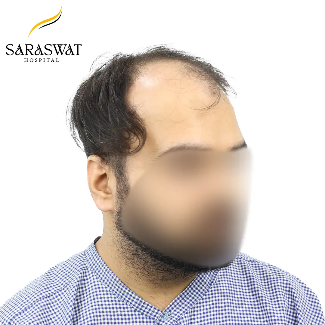 45 Degree Right FUE Hair Transplant Result Before Procedure