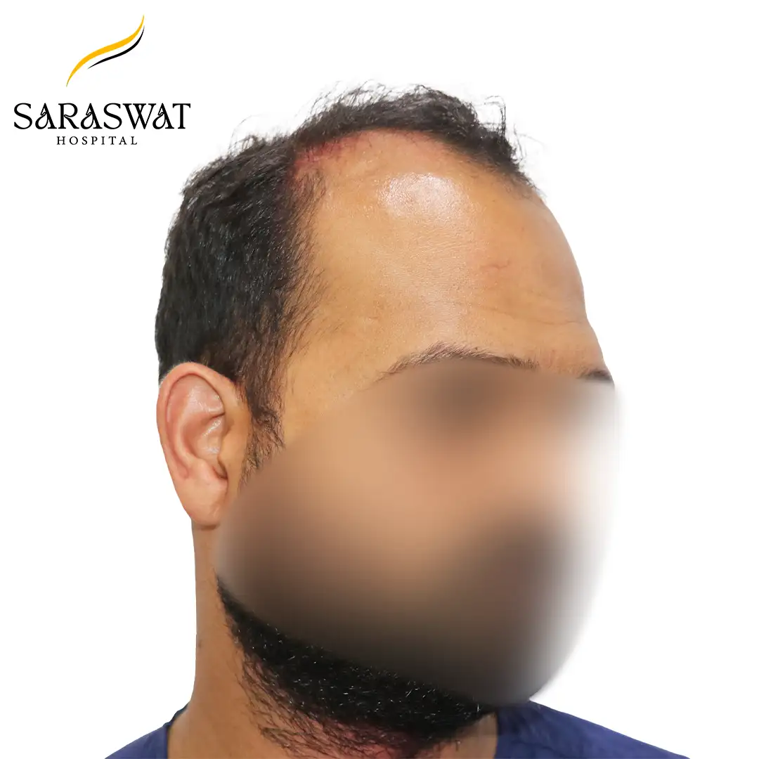 45 Degree Right FUE Hair Transplant Result Before Procedure