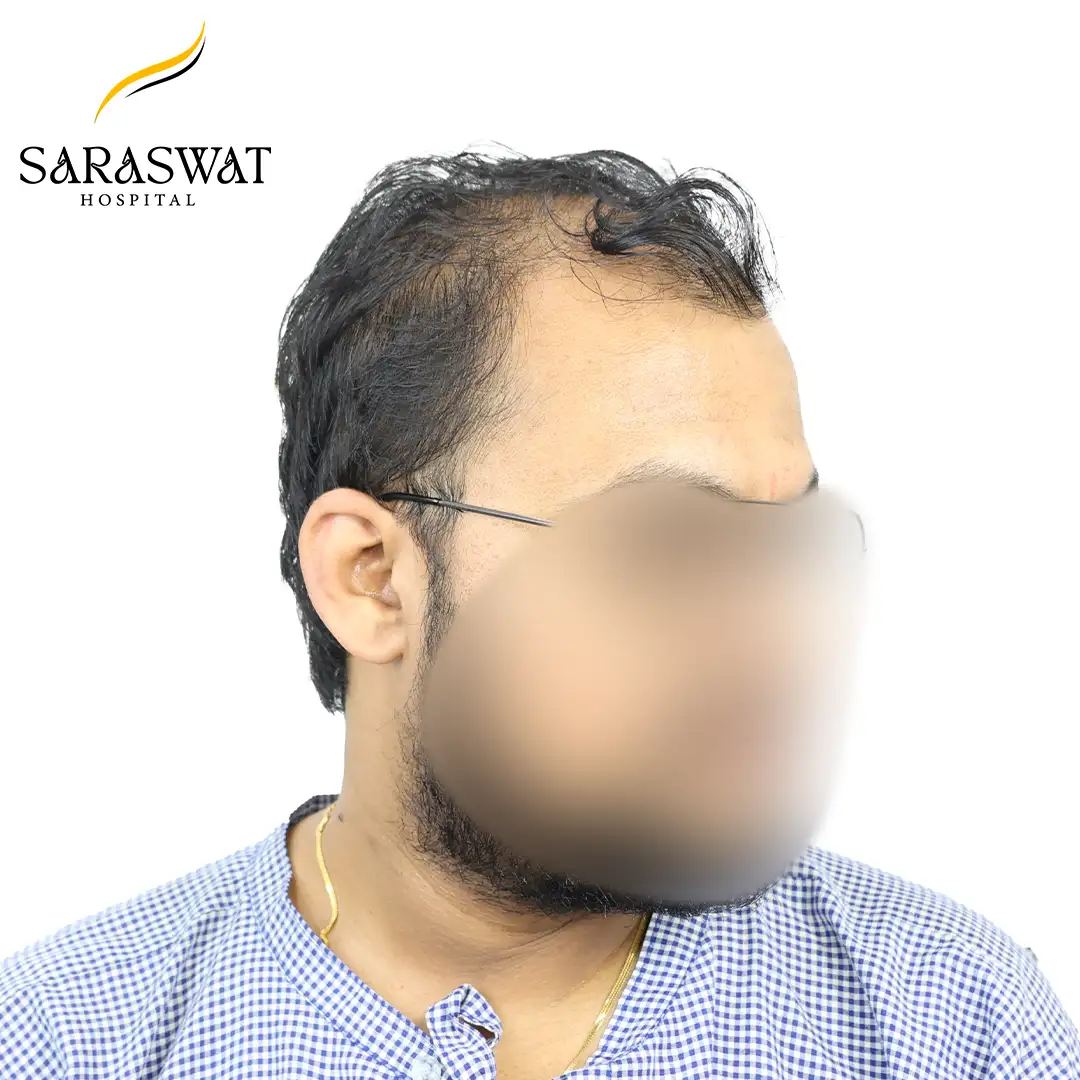 45 Degree Right FUE Hair Transplant Result Before Procedure