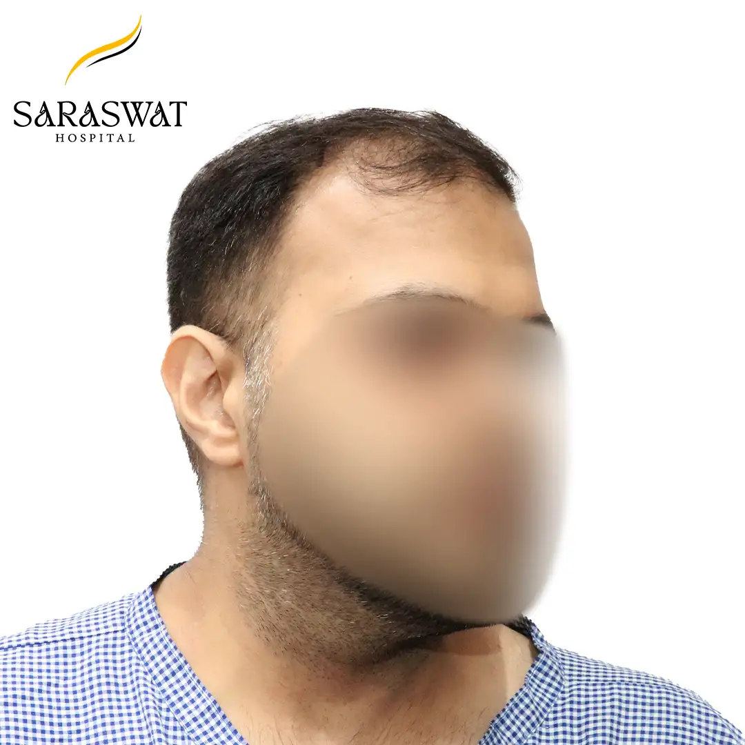 Hair Transplant Result