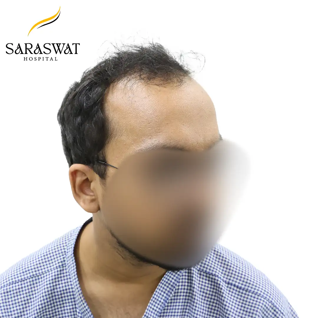 45 Degree Right FUE Hair Transplant Result Before Procedure