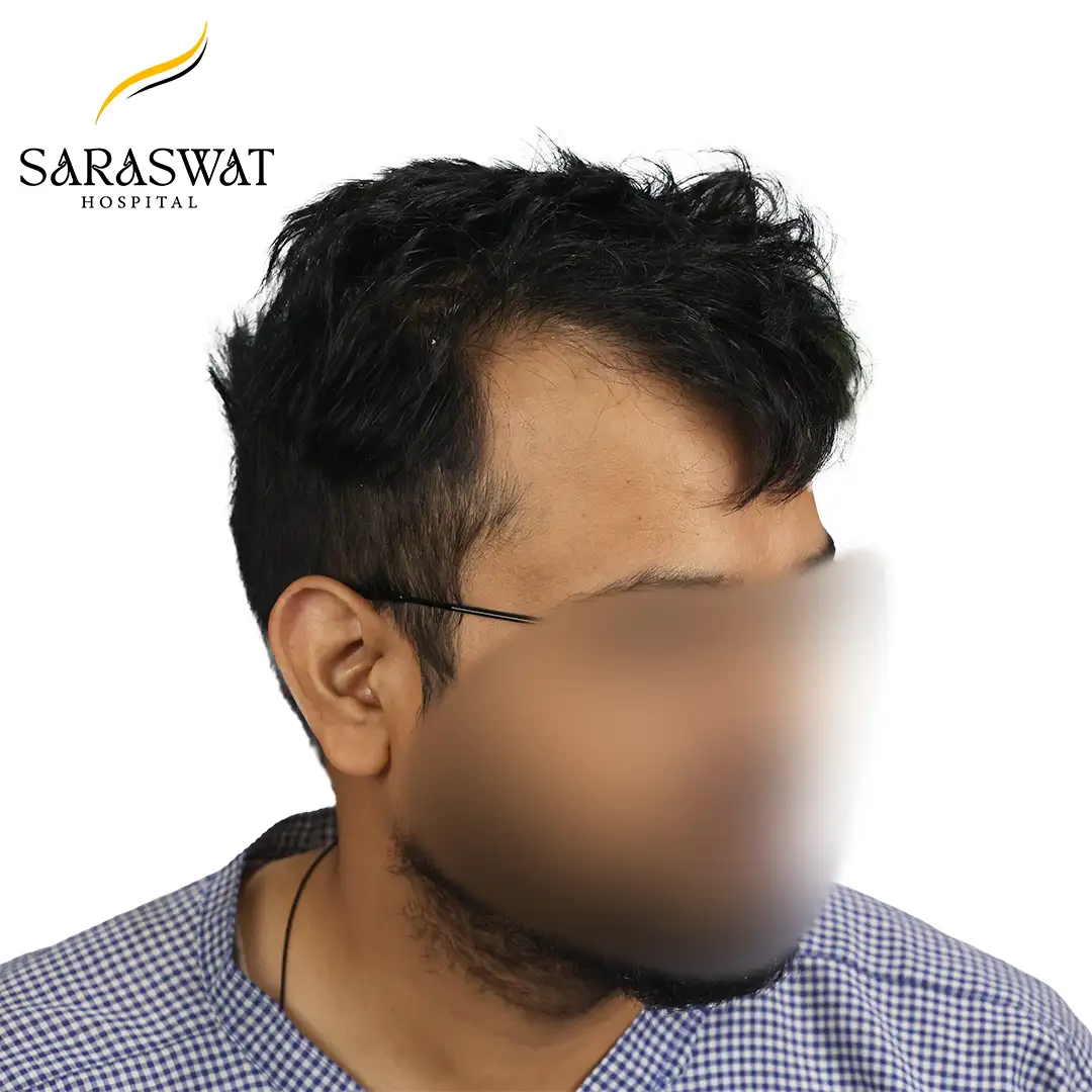 45 Degree Right FUE Hair Transplant Result Before Procedure