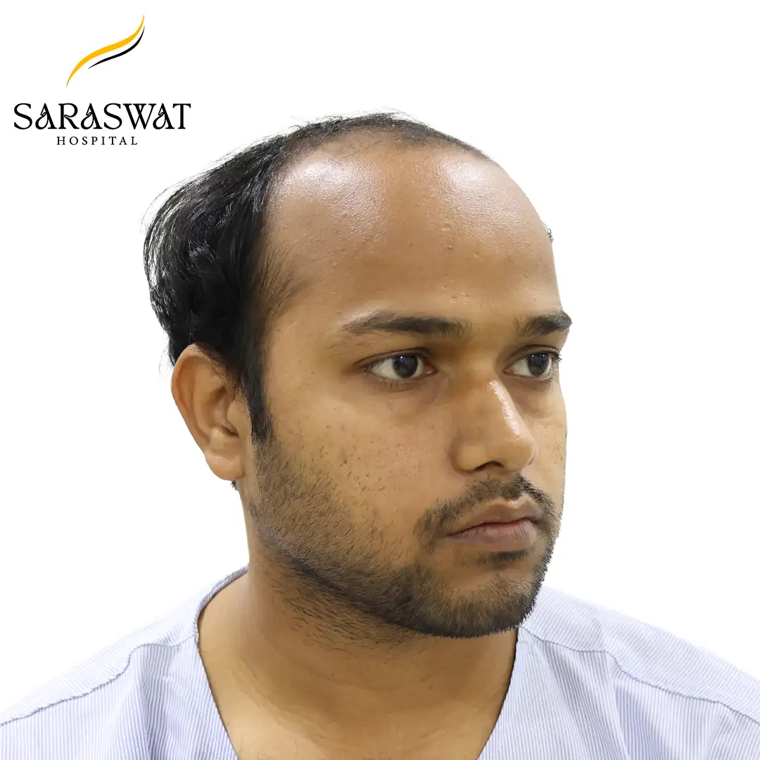 45 Degree Right FUE Hair Transplant Result Before Procedure