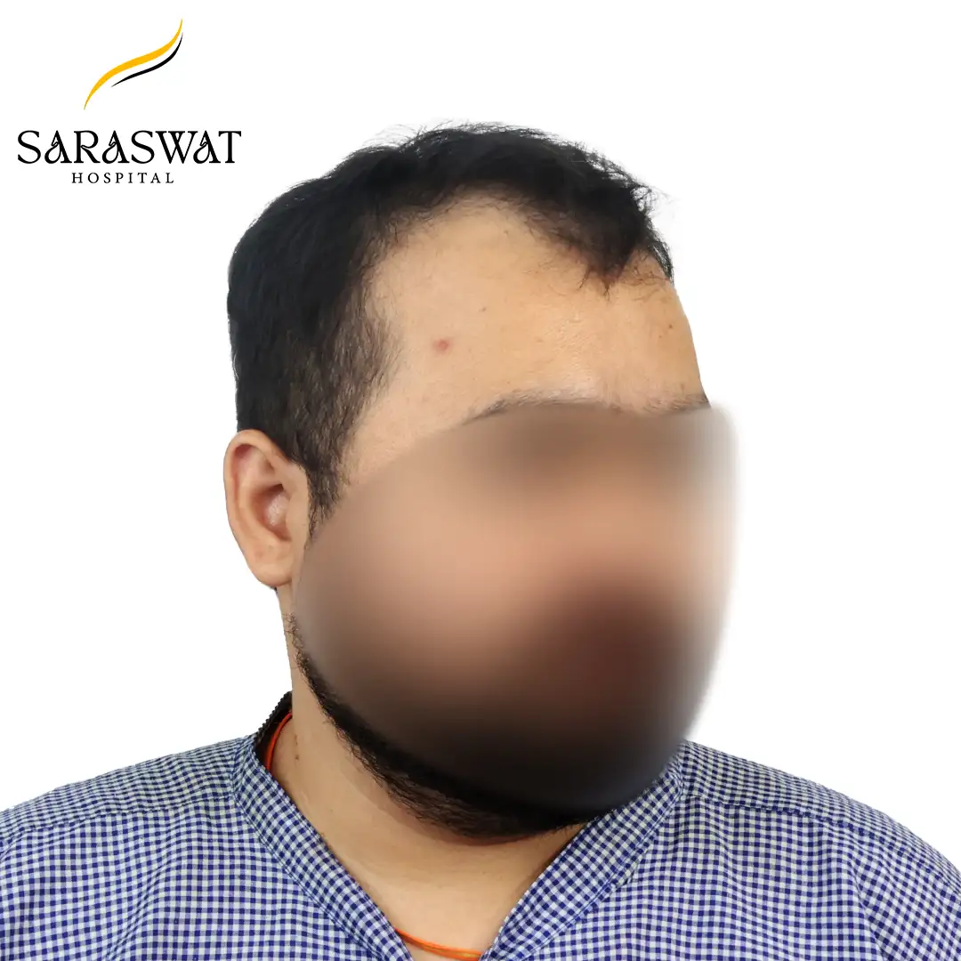 45 Degree Right FUE Hair Transplant Result Before Procedure