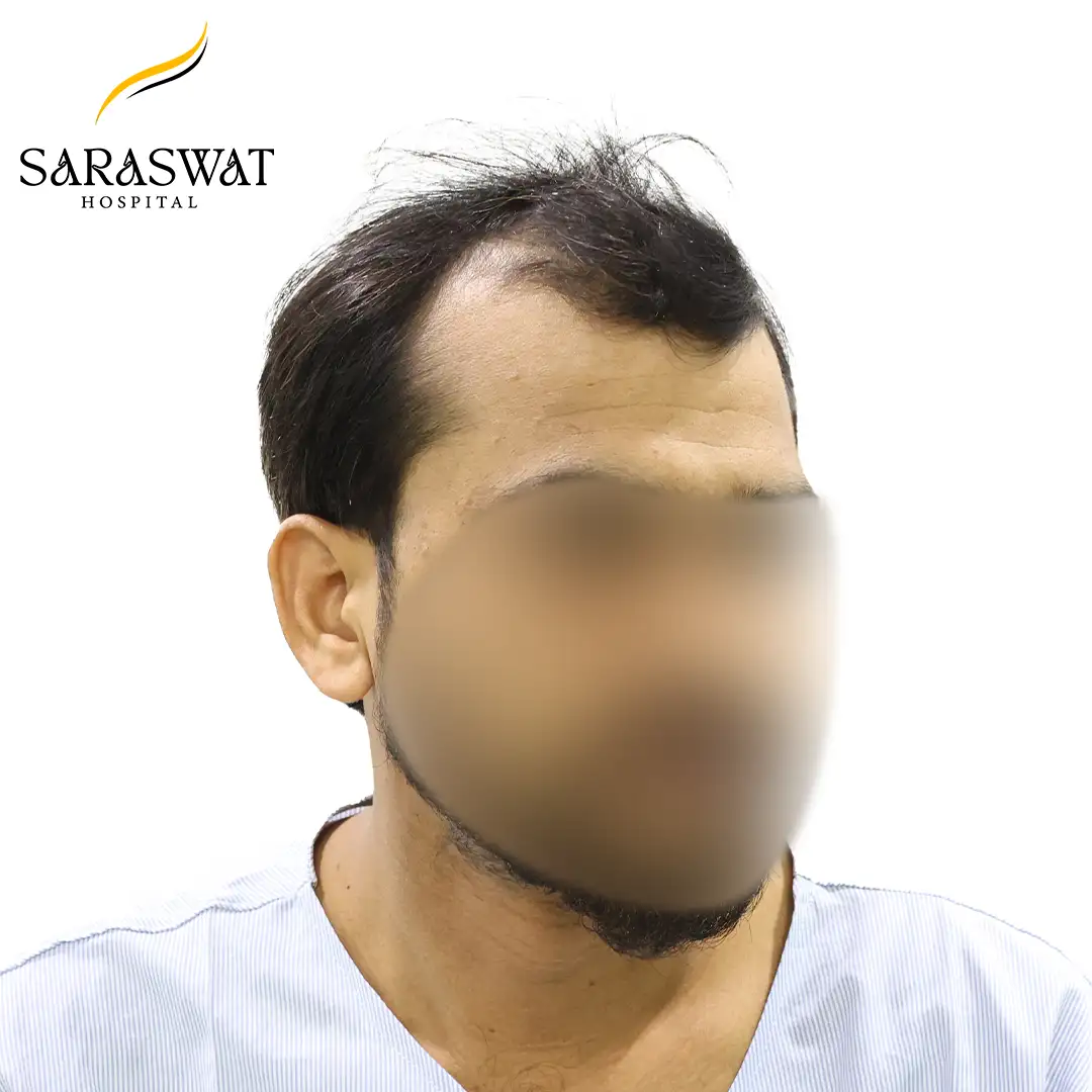 45 Degree Right FUE Hair Transplant Result Before Procedure