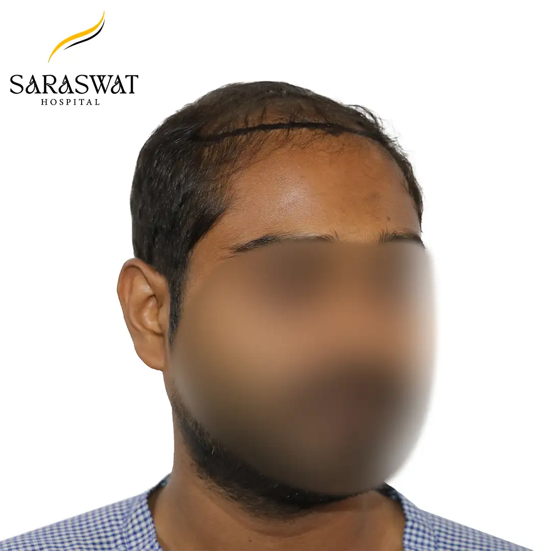 45 Degree Right FUE Hair Transplant Result Before Procedure