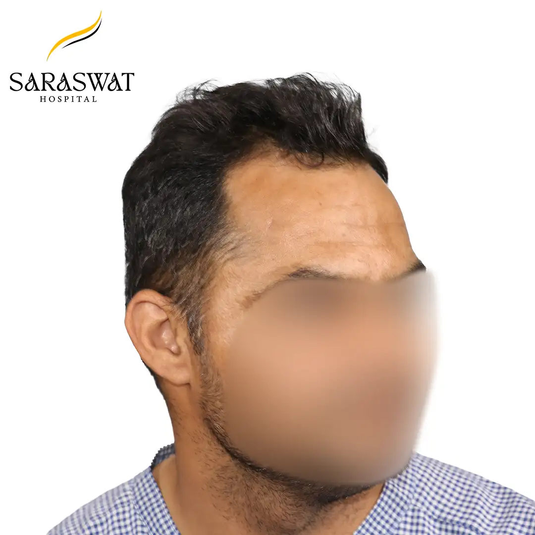45 Degree Right FUE Hair Transplant Result Before Procedure