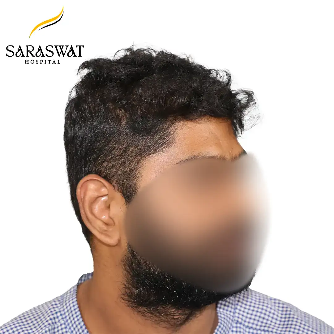 90 Degree FUE Hair Transplant Result Before Procedure