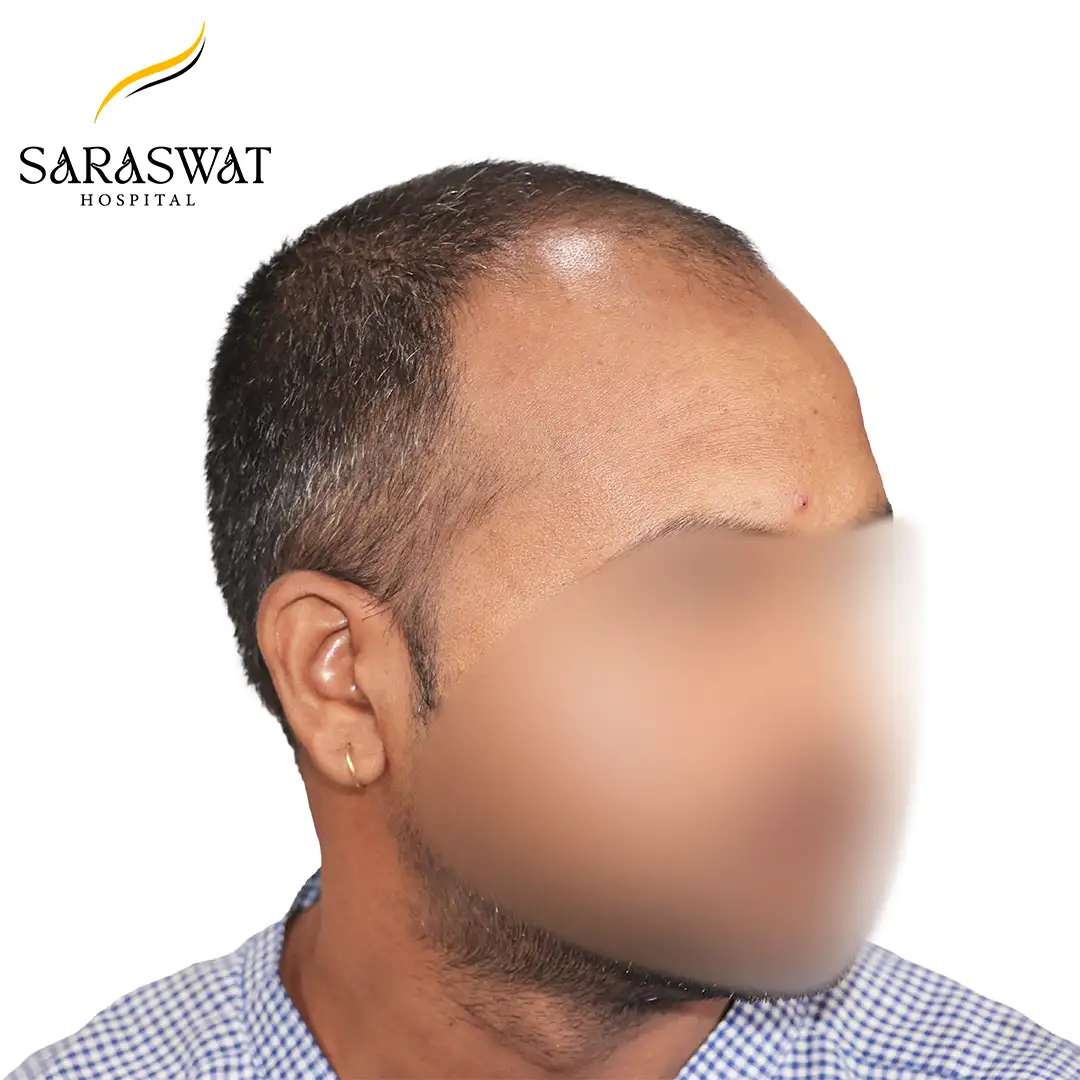 45 Degree Right FUE Hair Transplant Result Before Procedure