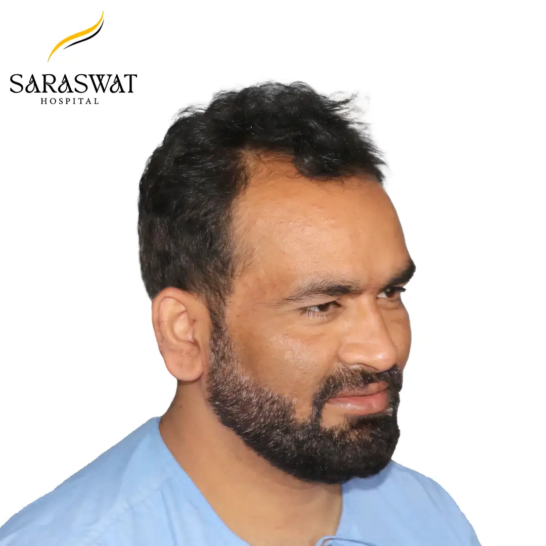 45 Degree Right FUE Hair Transplant Result Before Procedure