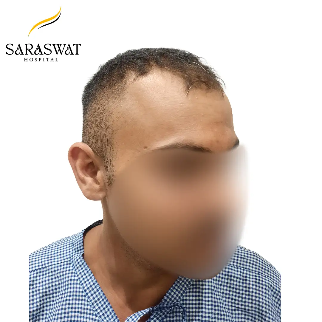 Hair Transplant Result