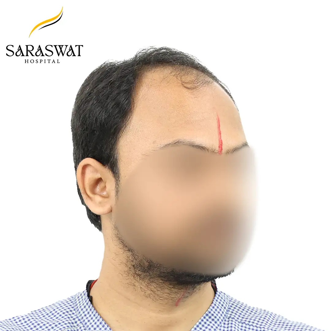 Hair Transplant Before and After Results
