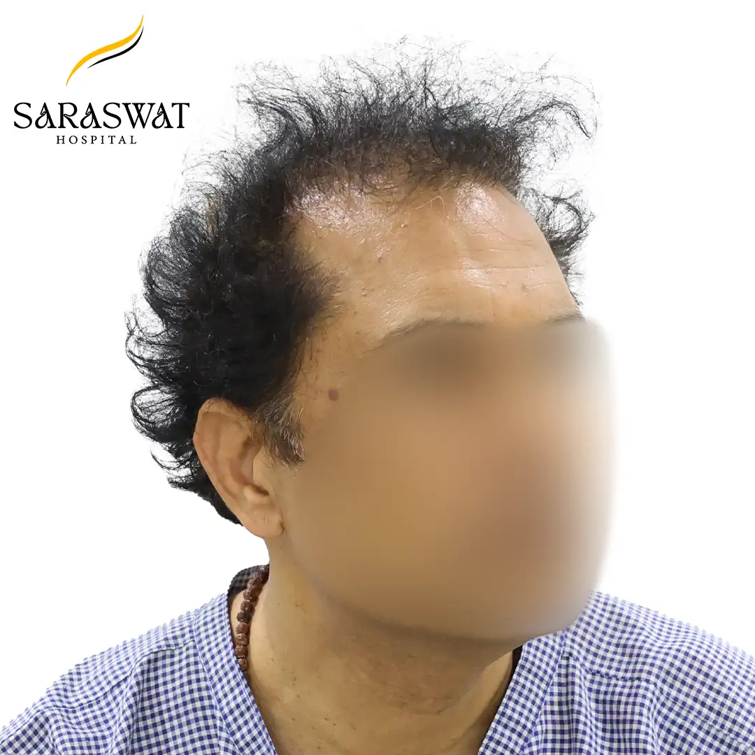 Best Hair Transplant Results