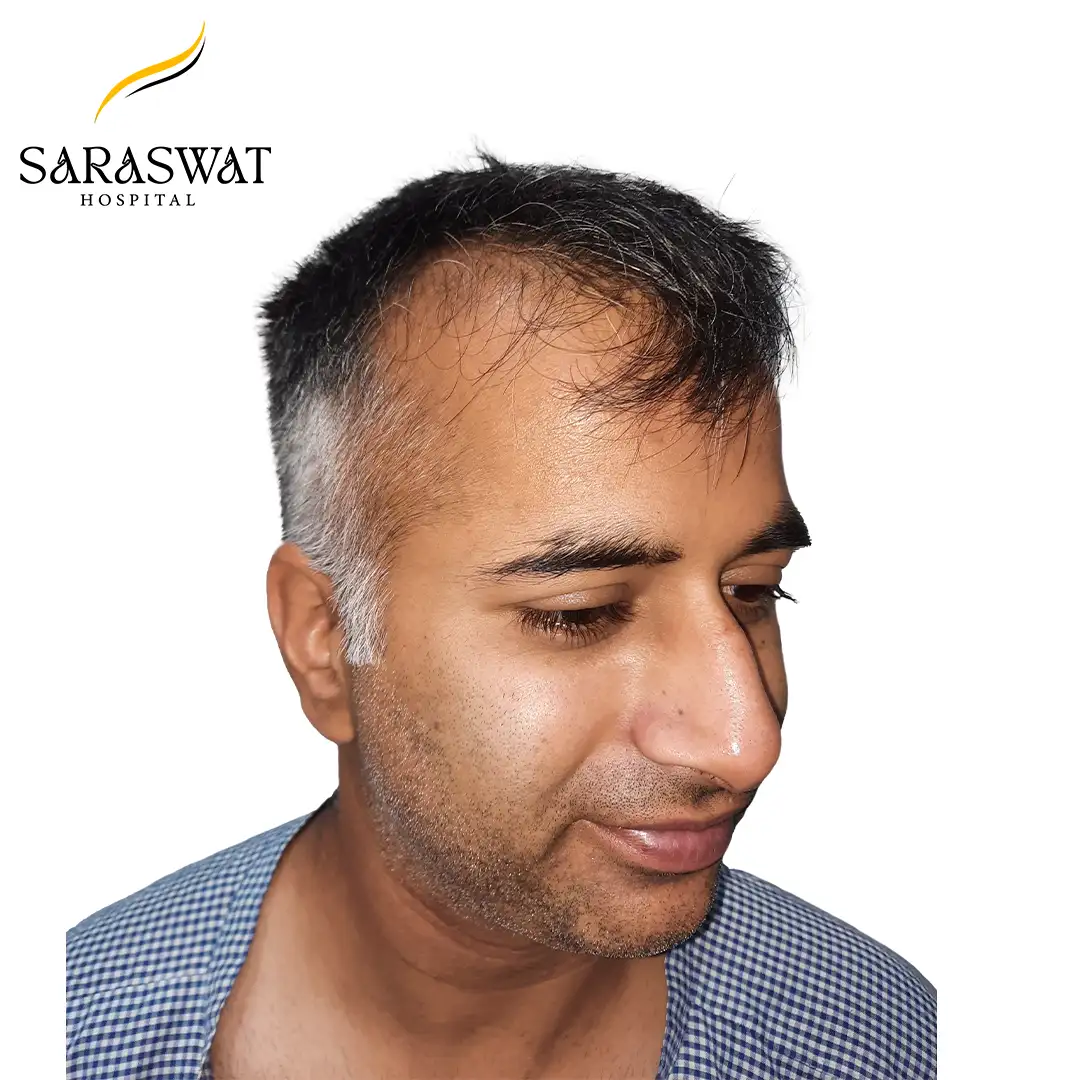 45 Degree Right FUE Hair Transplant Result Before Procedure