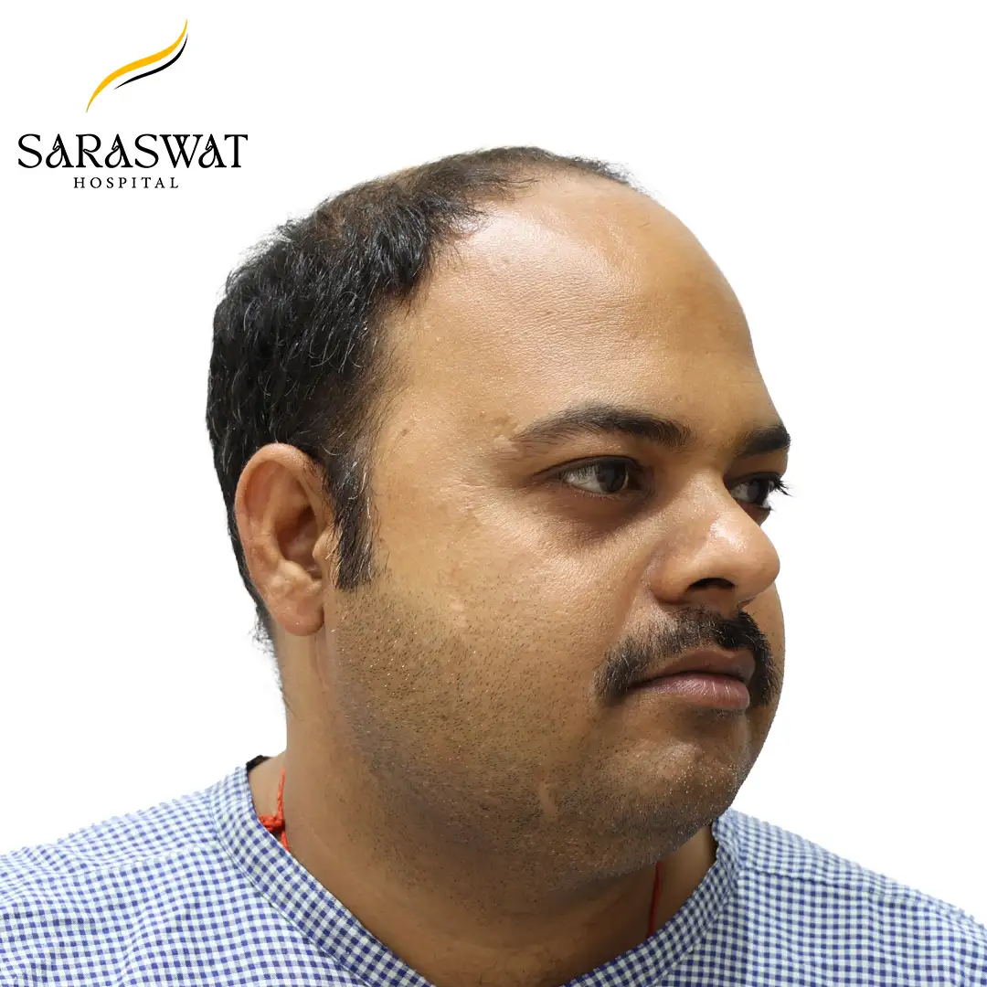 45 Degree Right FUE Hair Transplant Result Before Procedure