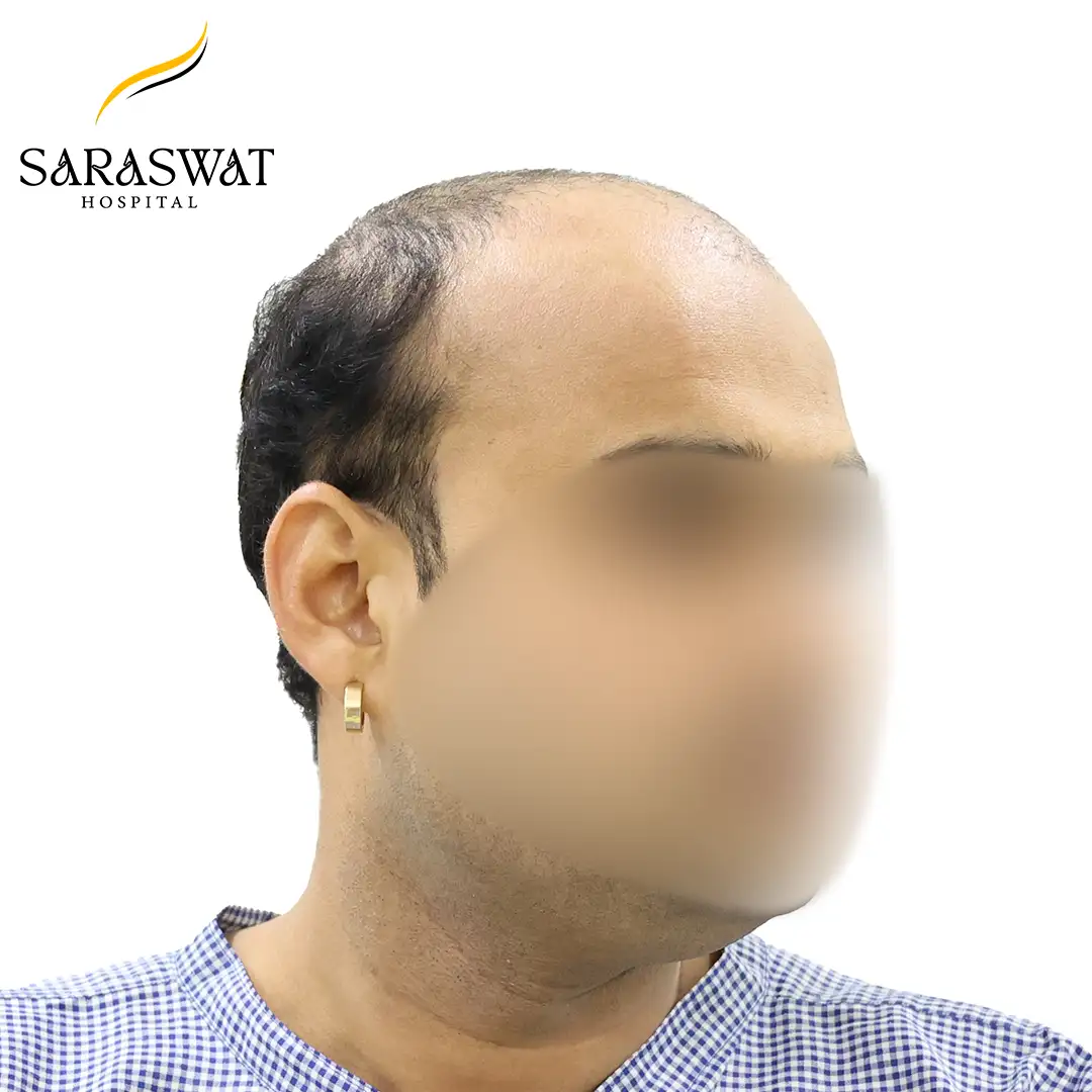 45 Degree Right FUE Hair Transplant Result Before Procedure