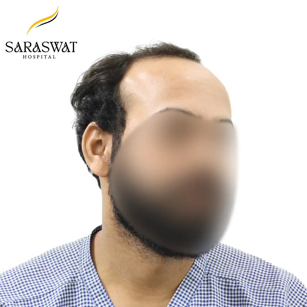 45 Degree Right FUE Hair Transplant Result Before Procedure