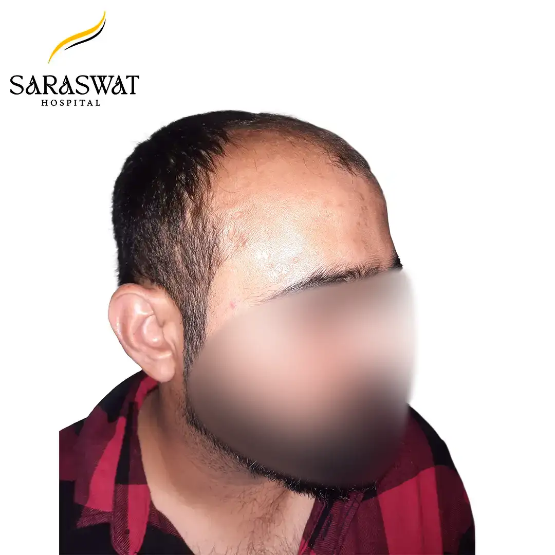 Hair Transplant Before and After Result