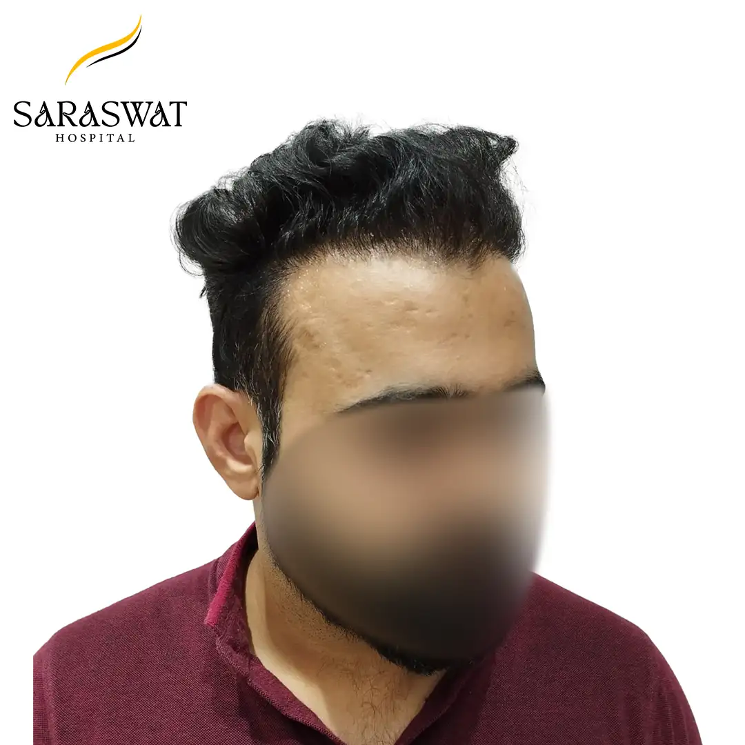 Hair Transplant Before and After Result