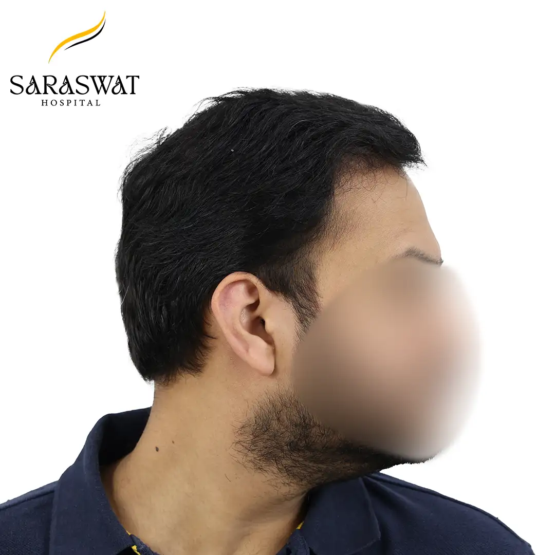 90 Degree Right FUE Hair Transplant Result After Procedure