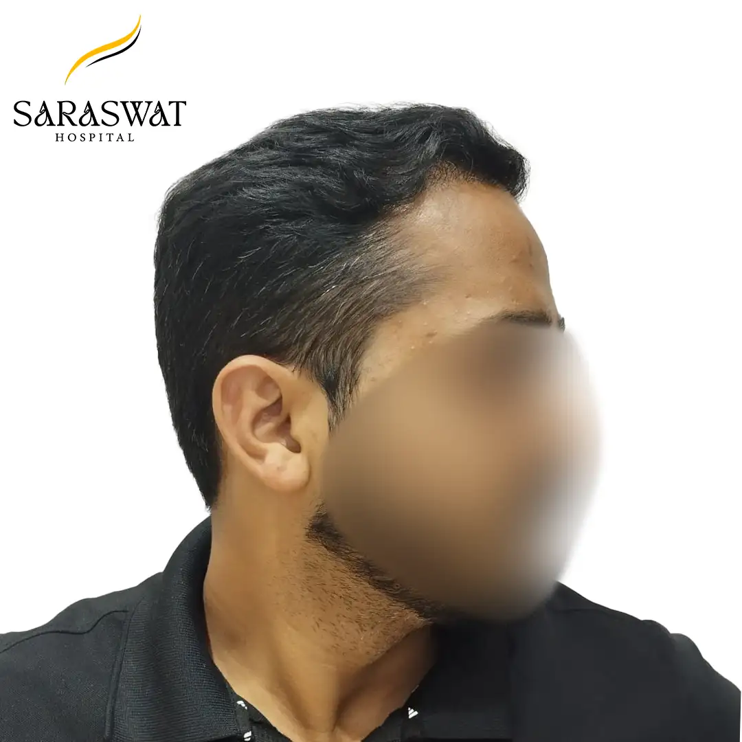 90 Degree Right FUE Hair Transplant Result After Procedure