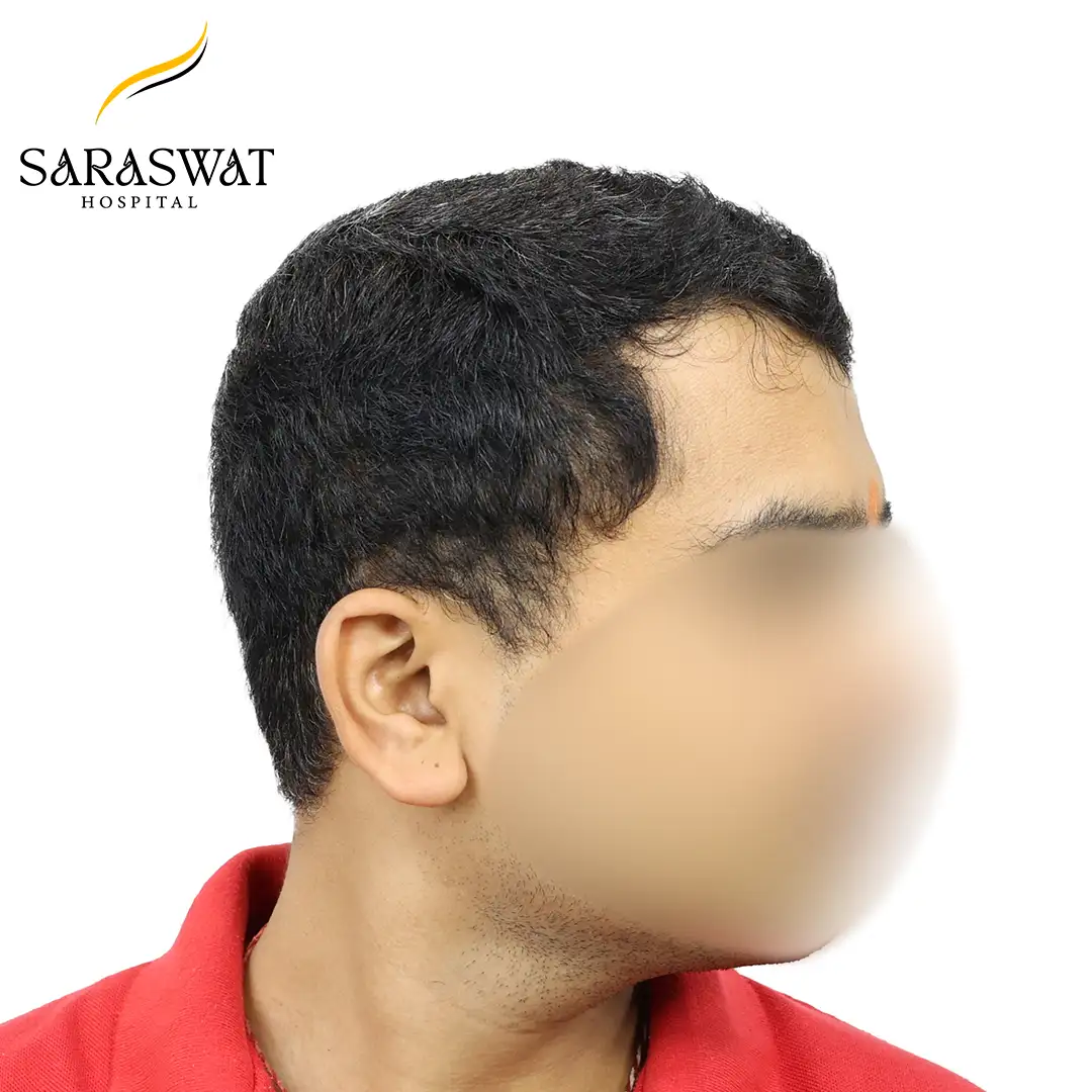 90 Degree Right FUE Hair Transplant Result After Procedure