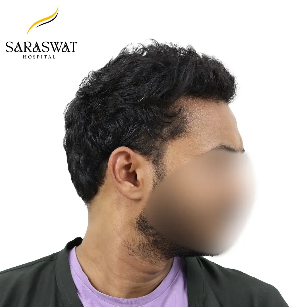 90 Degree Right FUE Hair Transplant Result After Procedure