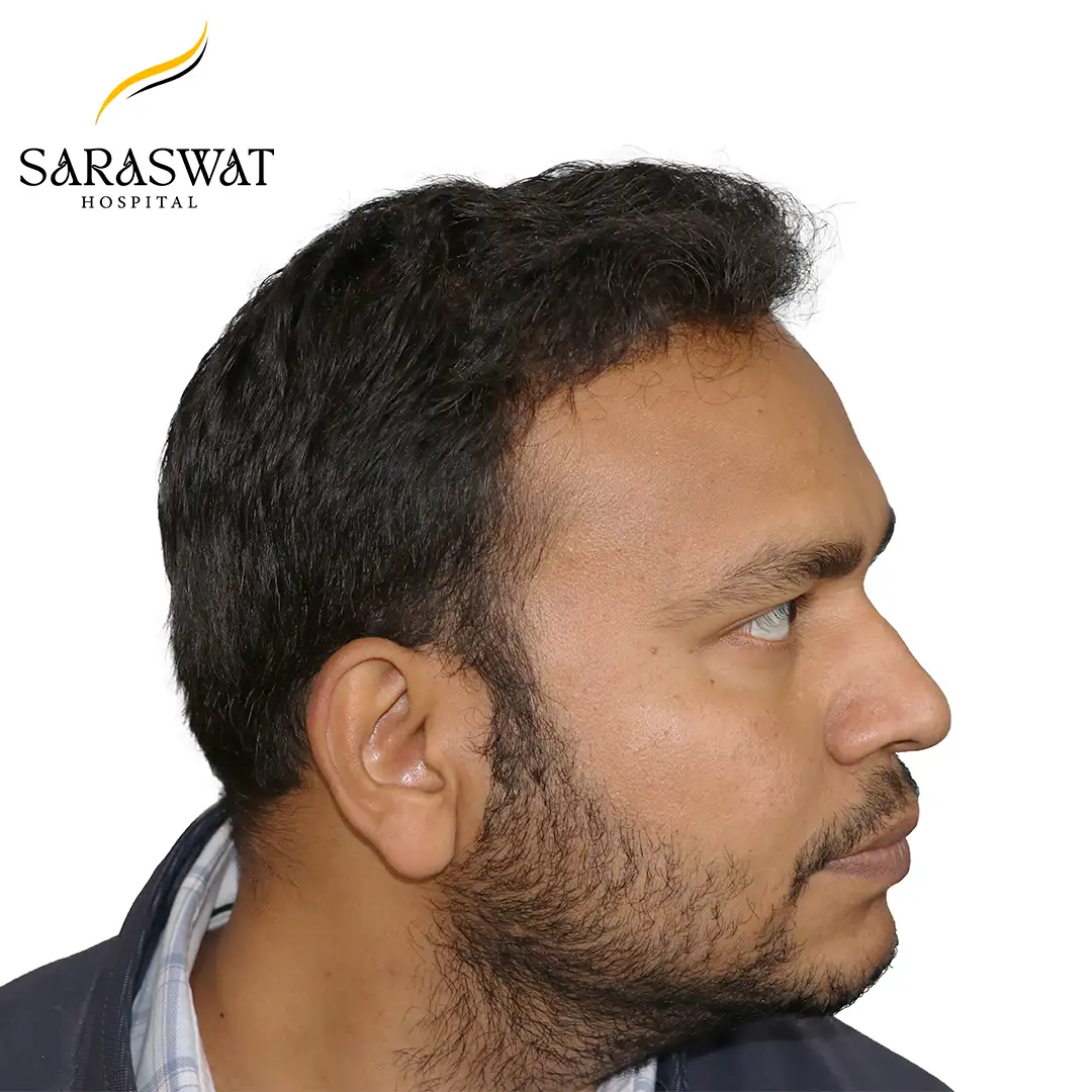 90 Degree Right FUE Hair Transplant Result After Procedure