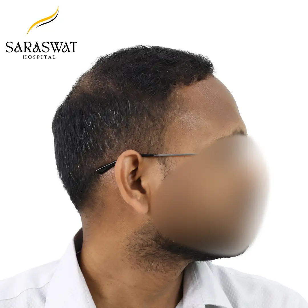 Hair Transplant Before and After Results