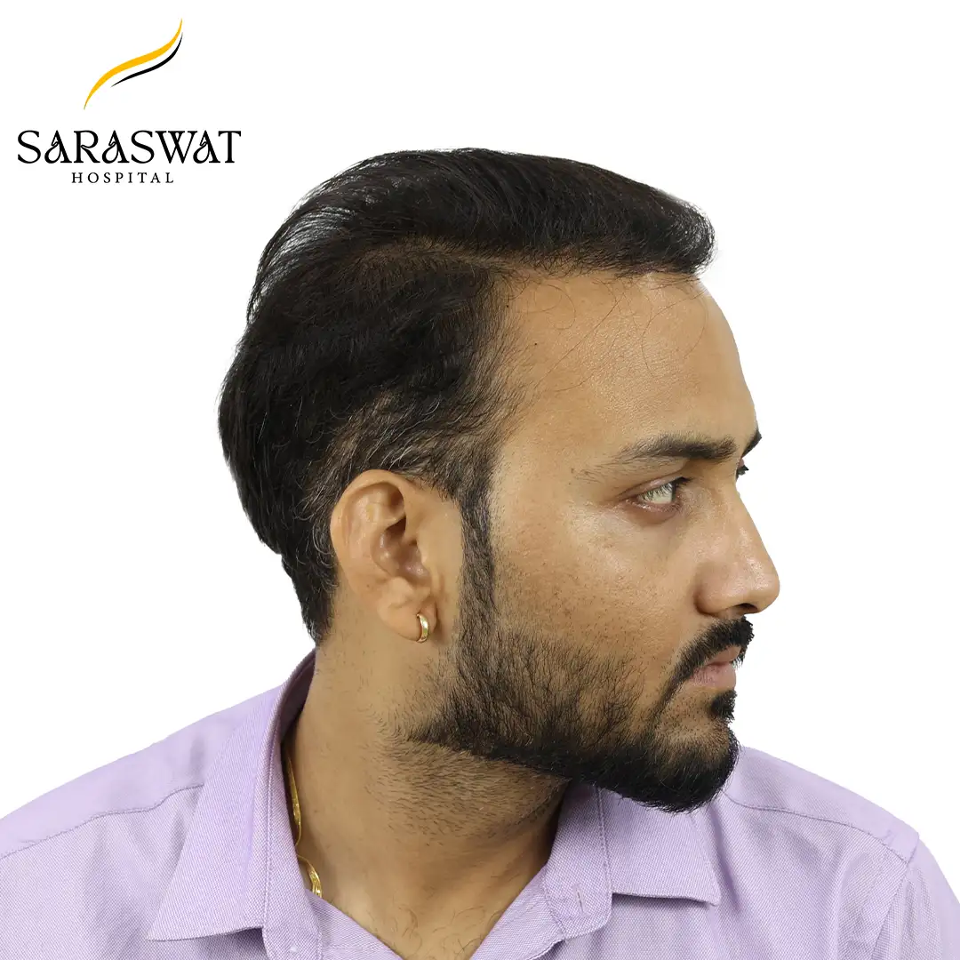 90 Degree Right FUE Hair Transplant Result After Procedure