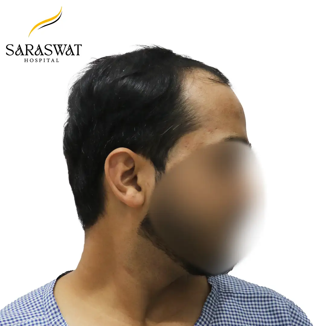 90 Degree Right FUE Hair Transplant Result Before Procedure