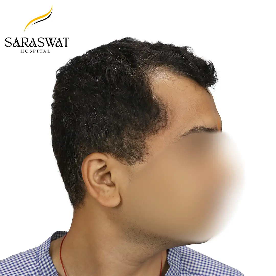 90 Degree Right FUE Hair Transplant Result Before Procedure