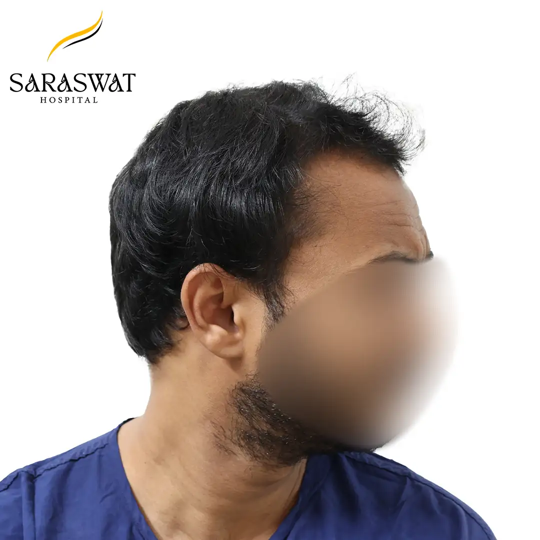 90 Degree Right FUE Hair Transplant Result Before Procedure