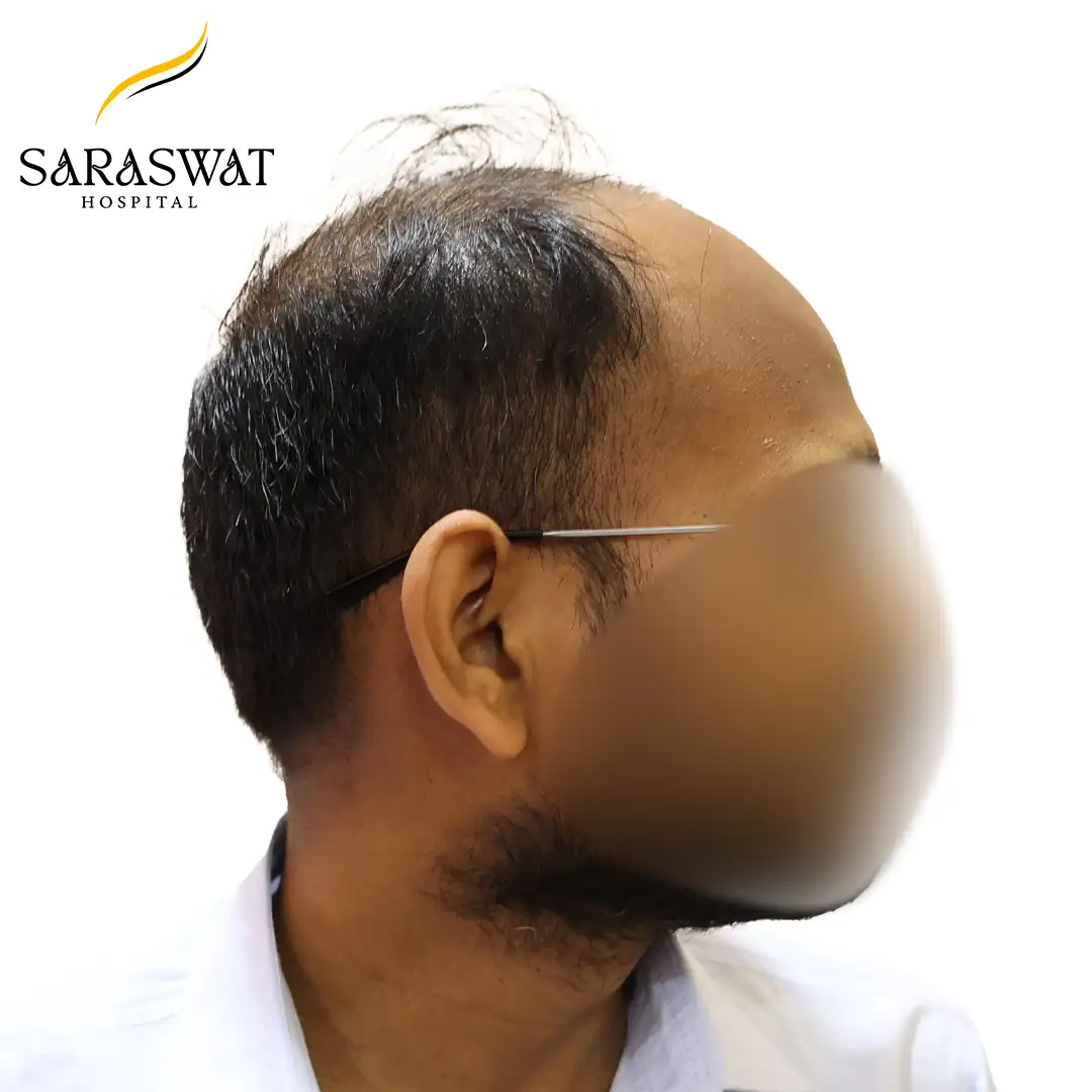 Hair Transplant Before and After Results