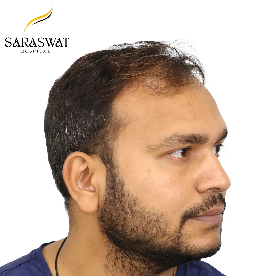 90 Degree Right FUE Hair Transplant Result Before Procedure