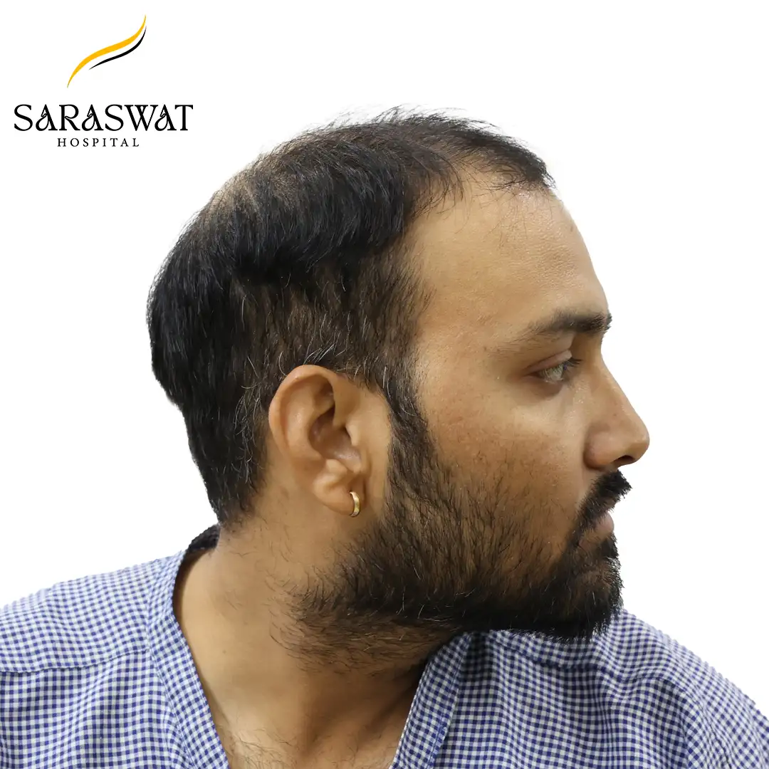 90 Degree Right FUE Hair Transplant Result Before Procedure