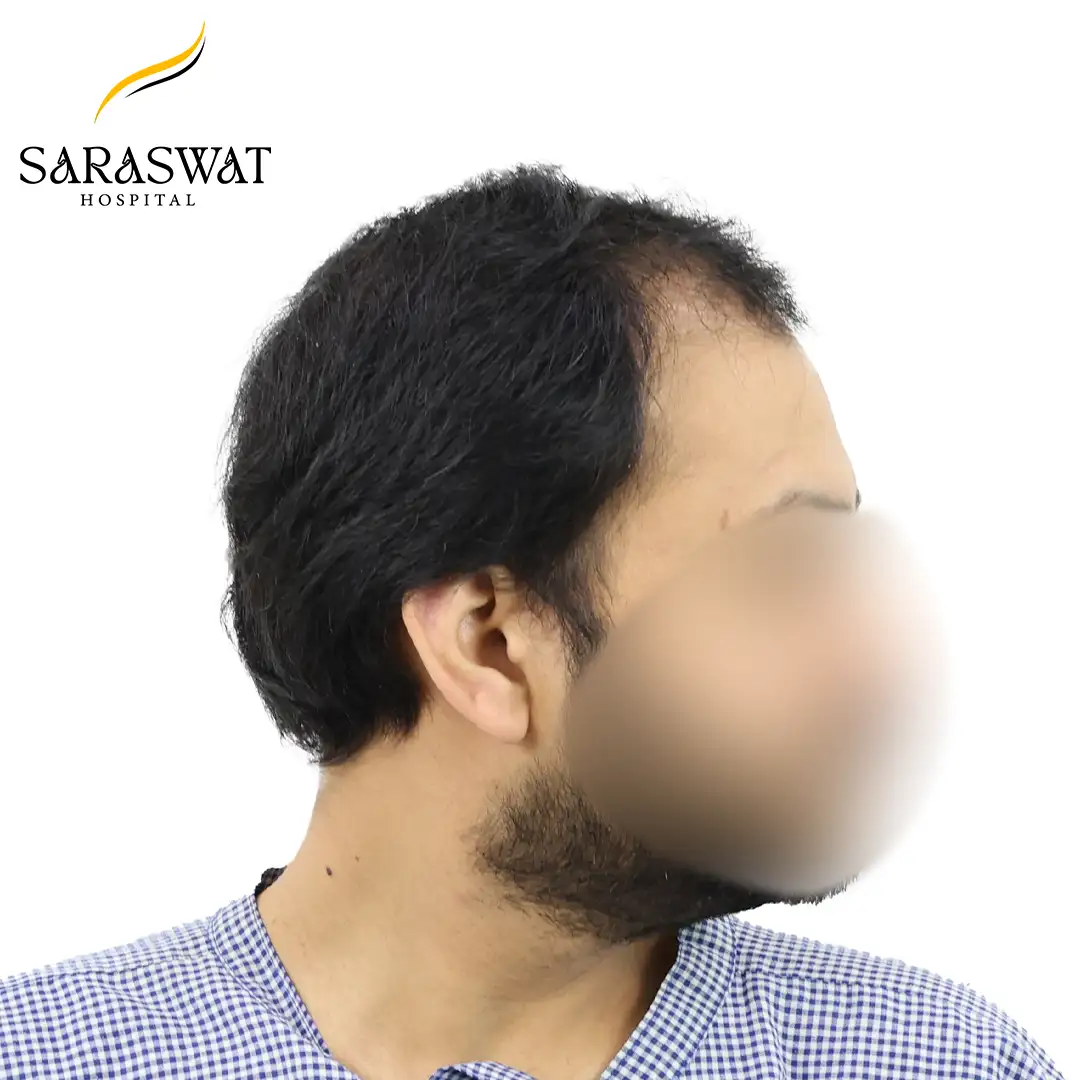 90 Degree Right FUE Hair Transplant Result Before Procedure