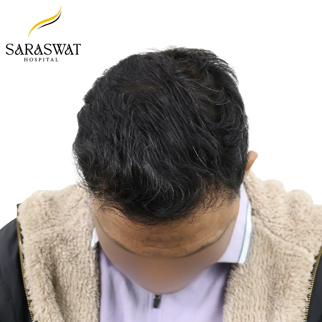 Top FUE Hair Transplant Result After Procedure