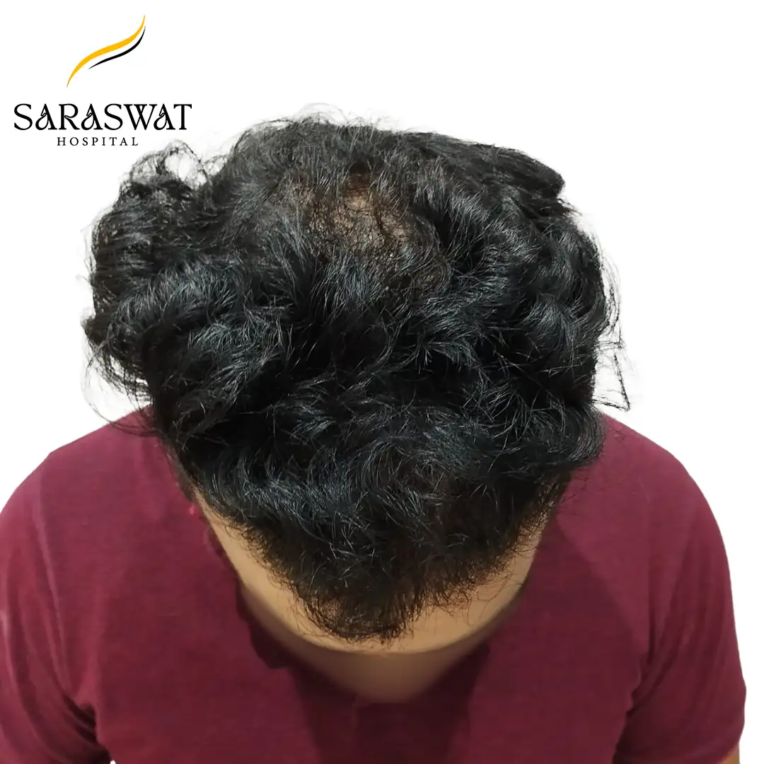 Hair Transplant Before and After Result